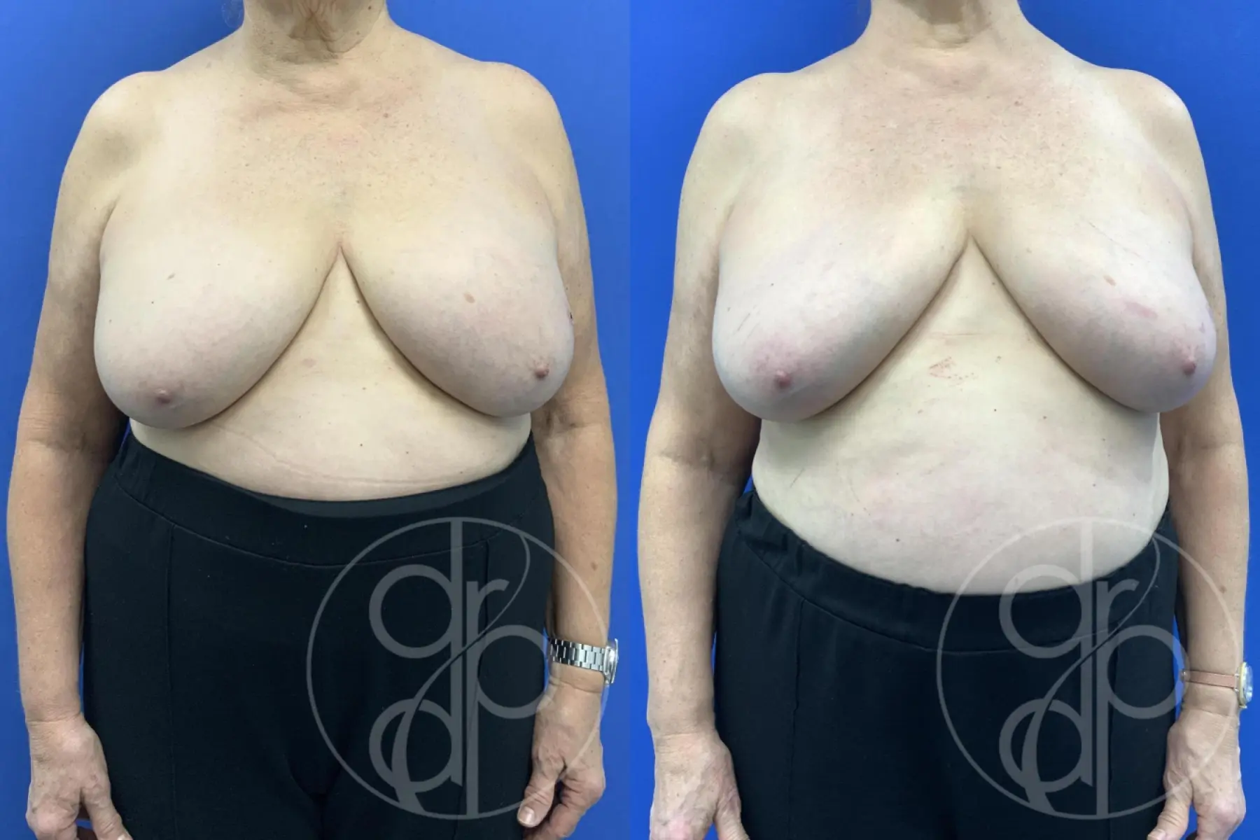 Patient 14989 breast implant removal before and after result - Before and After