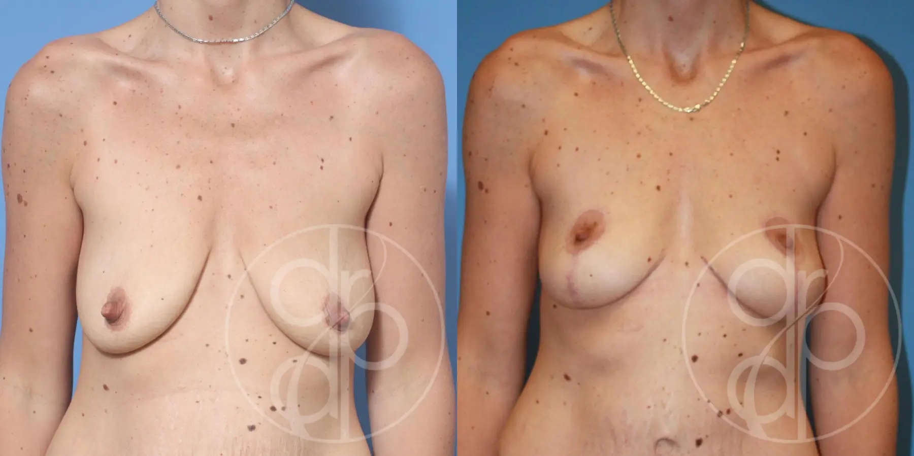 patient 13038 breast lift before and after result - Before and After
