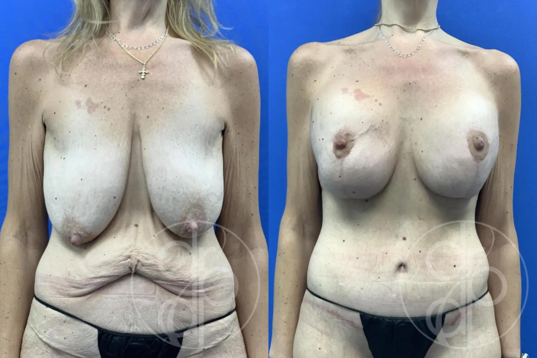patient 11917 breast augmentation with lift before and after result - Before and After
