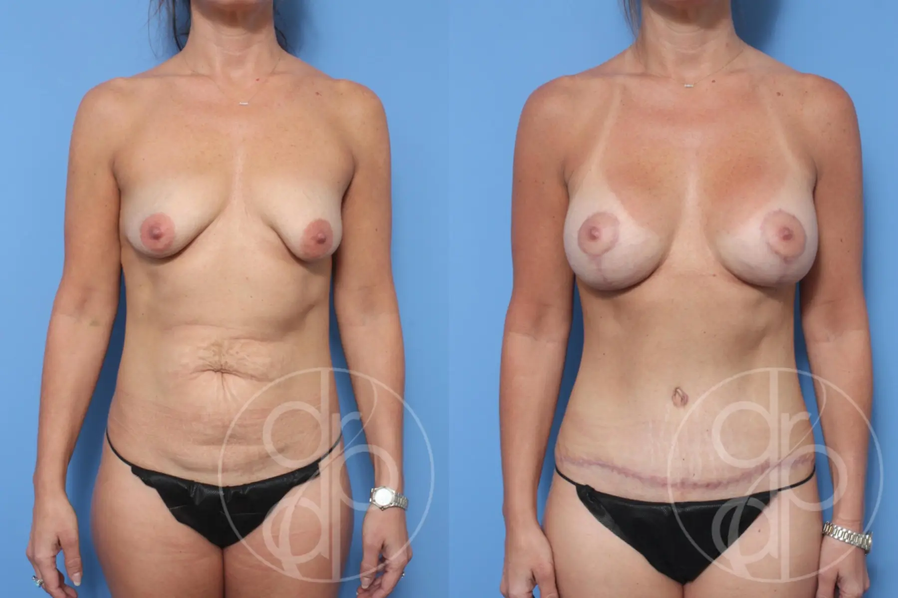 patient 10280 breast augmentation with lift before and after result - Before and After