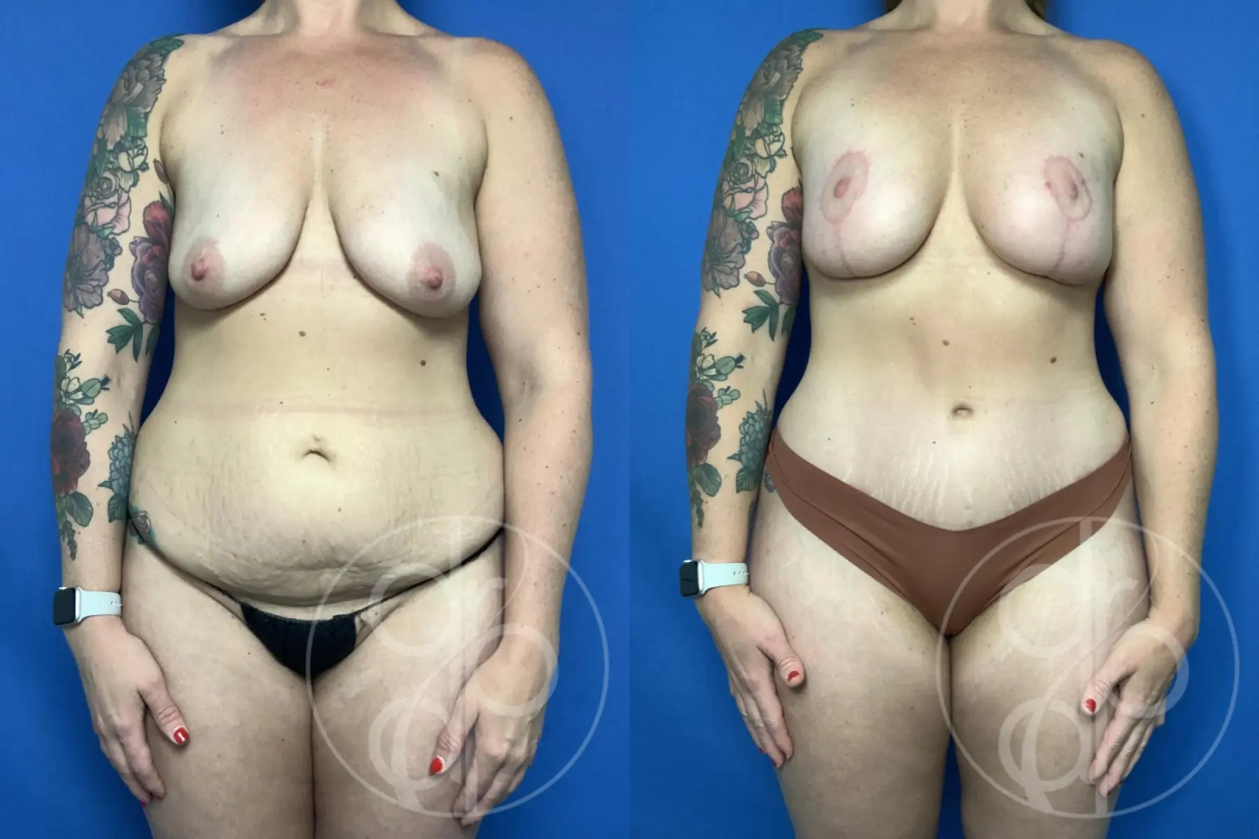 patient 14139 breast augmentation with lift before and after result - Before and After