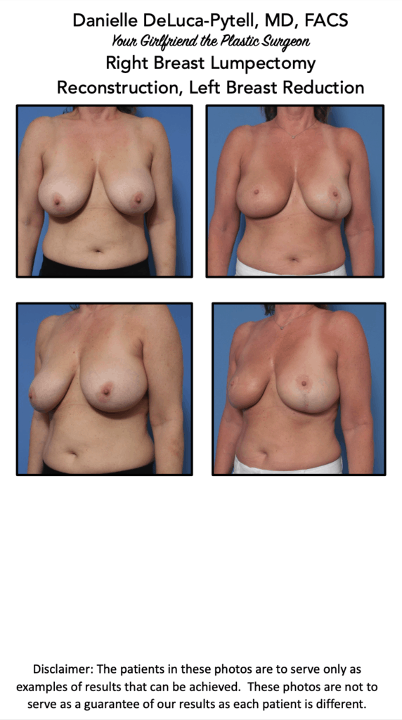 breast reconstruction photo book