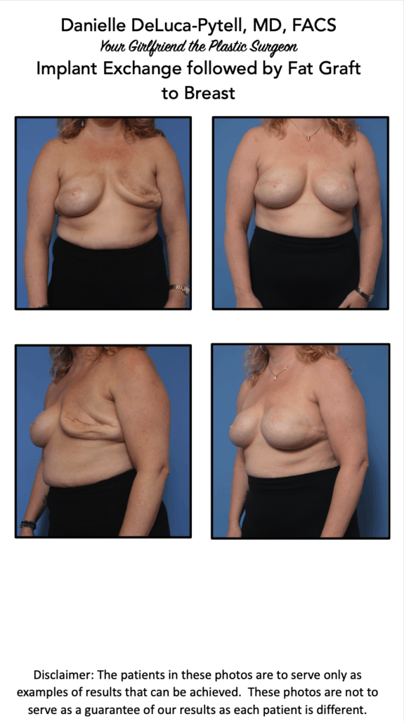 breast reconstruction photo book
